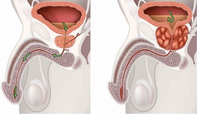 Healthy and bad prostate