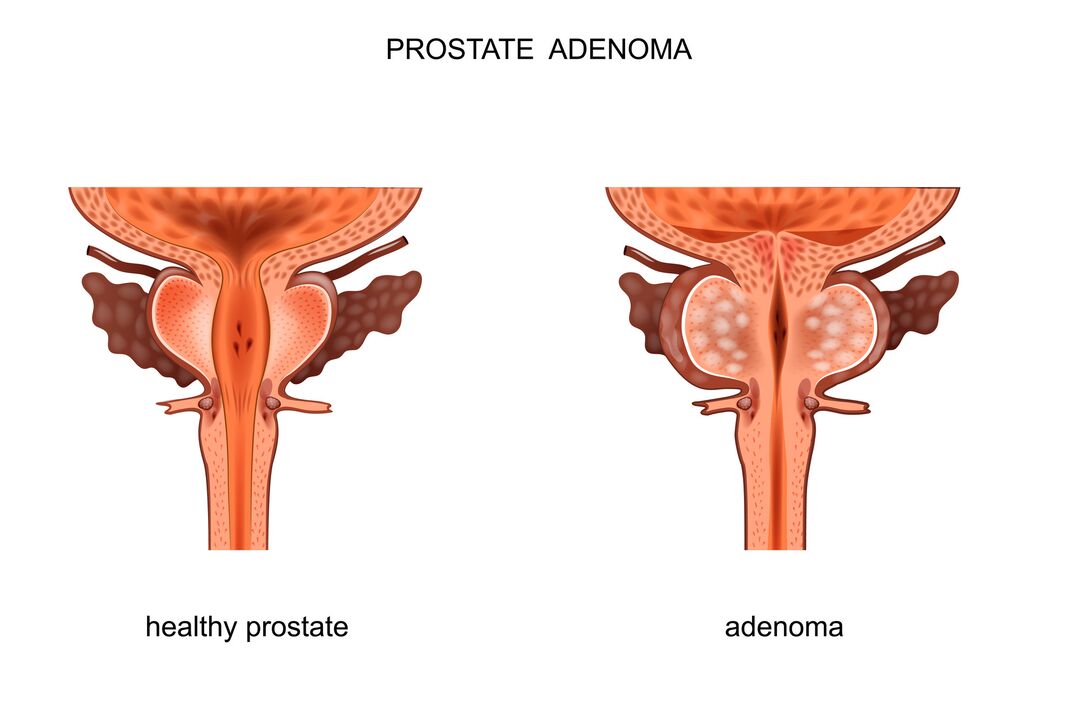 Healthy prostate and adenoma